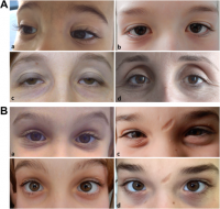 Classical Ehlers-Danlos Syndrome - Healthwatch Central Bedfordshire